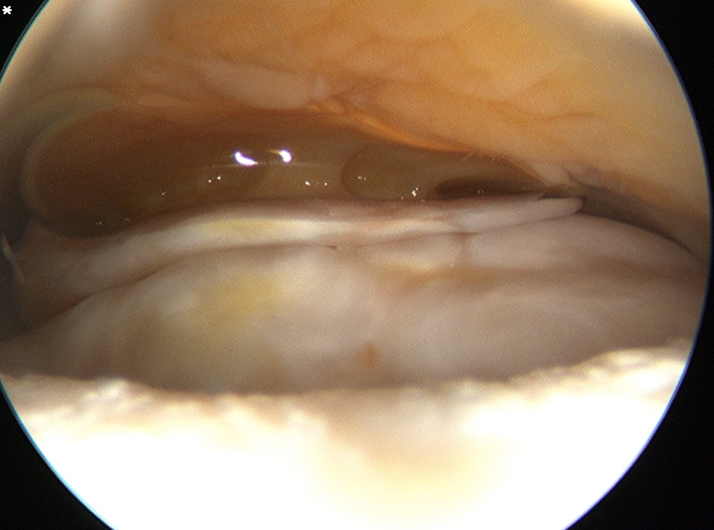 Hill Sachs Lesion Superior